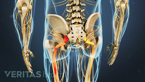Vista posterior del dolor que se irradia hacia el nervio ciático de la pierna.