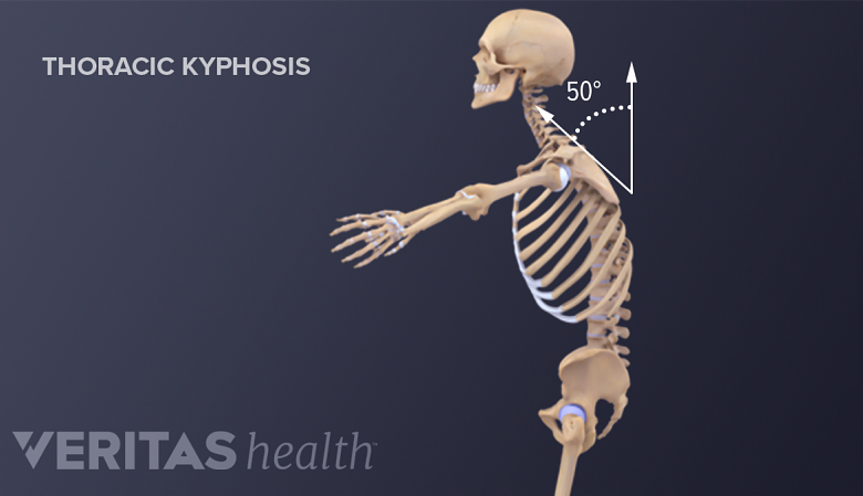 Illustration of a skeleton showing thoracic kyphosis.