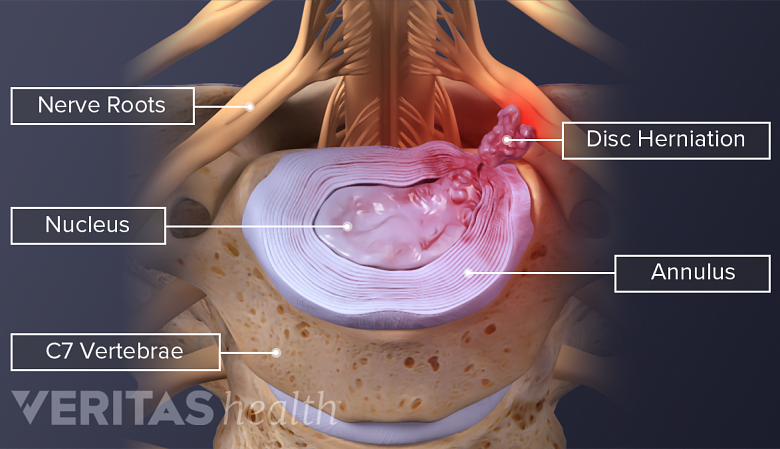 Illustration showing c7 vertebra showing herniation with nerve root inflammation.