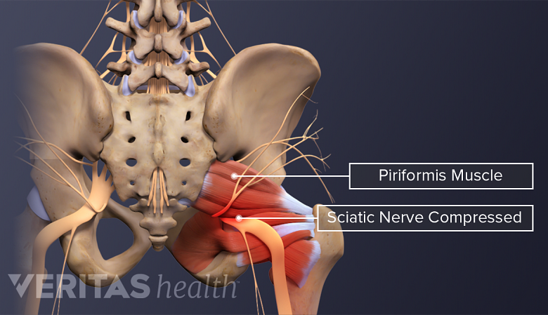 An illustration showing compressed sciatic nerve due to pressure within muscles.