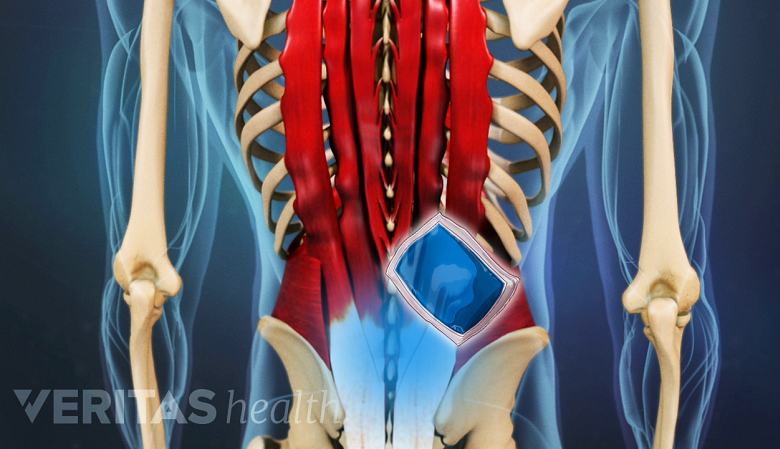 Illustration showing posterior view of torso with a ice pack icon in th lower back.