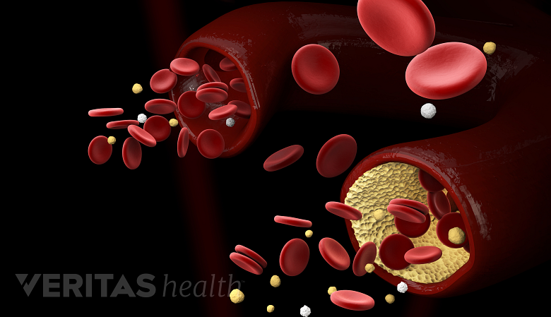 An illustration showing Cholesterol build up in the arteries.