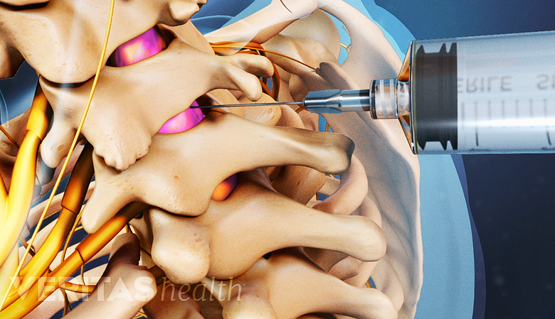 Illustration showing cervical vertebra with an injection.
