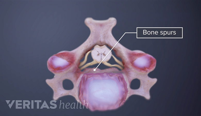 Medical illustration showing cervical vertebra with a bone spur.