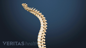 Spine illustrating curvature from kyphosis