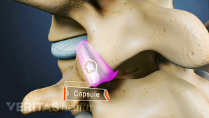 Capsule full of synovial fluid highlighted in the facet joint