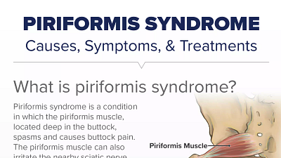 Piriformis Syndrome Overview