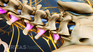 Medical illustration of the lumbar spine with the facet joints highlighted