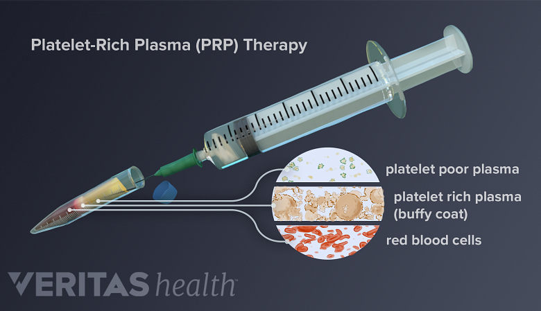 Illustration showing a syringe and a inset labelling: platelet rich plasma,platelet poor plasma and red blood cells.