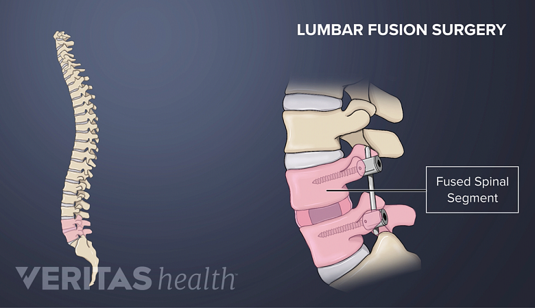 Illustration showing lumbar spinal fusion segment.
