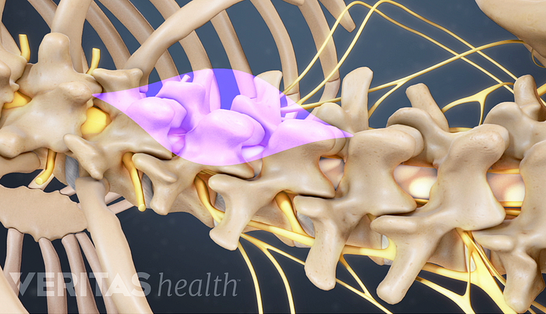 Illustration of spine with incision highlighted in pink.