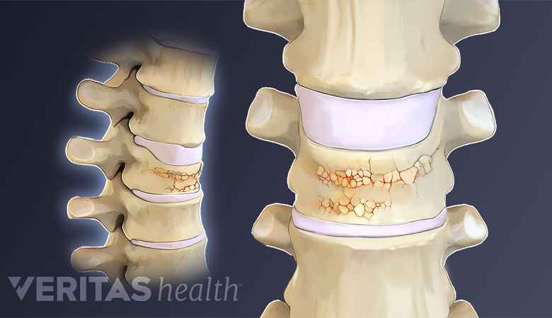 Illustration of vertebral compression fracture from osteoporosis