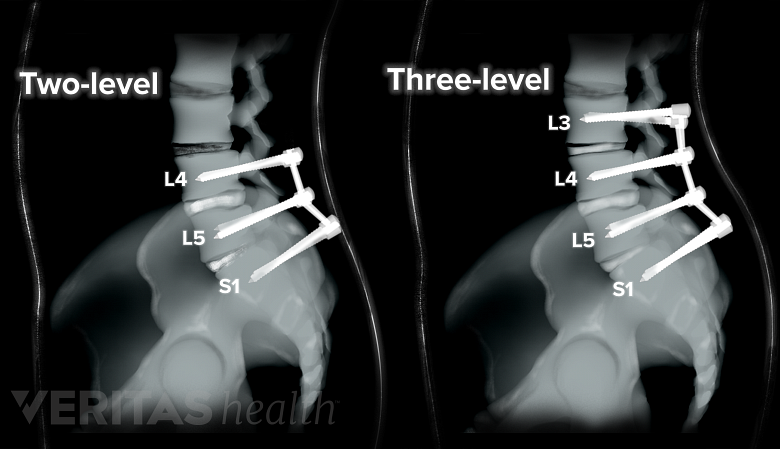 Spine surgery on more than one spinal level (multilevel spinal fusion).
