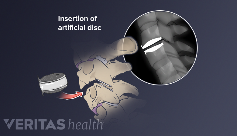 Illustration showing cervical spine with artificial disc insertd a inset showing x-ray of artificial disc.