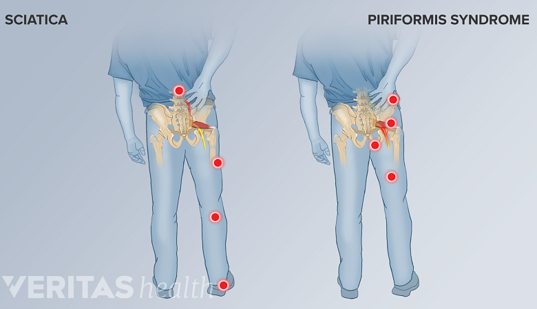 An illustration showing pain areas in sciatica and piriformis syndrome.