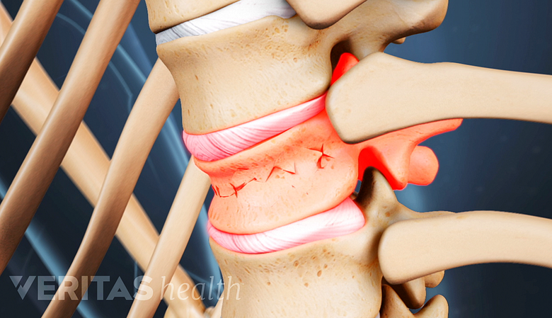 Illustration showing vertebral fracture.
